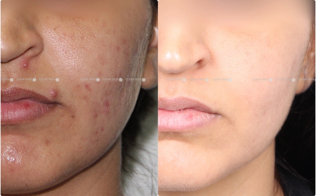 Acne Scars Results 6 Months Timeline Clear Skin Pune 4