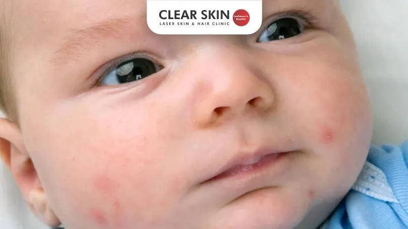 Acne in Babies Causes, Symptoms and Treatment Clear Skin Pune