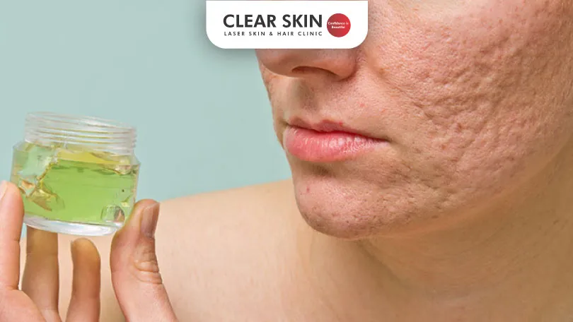 Aloe Vera for Acne Scars Clear Skin Pune