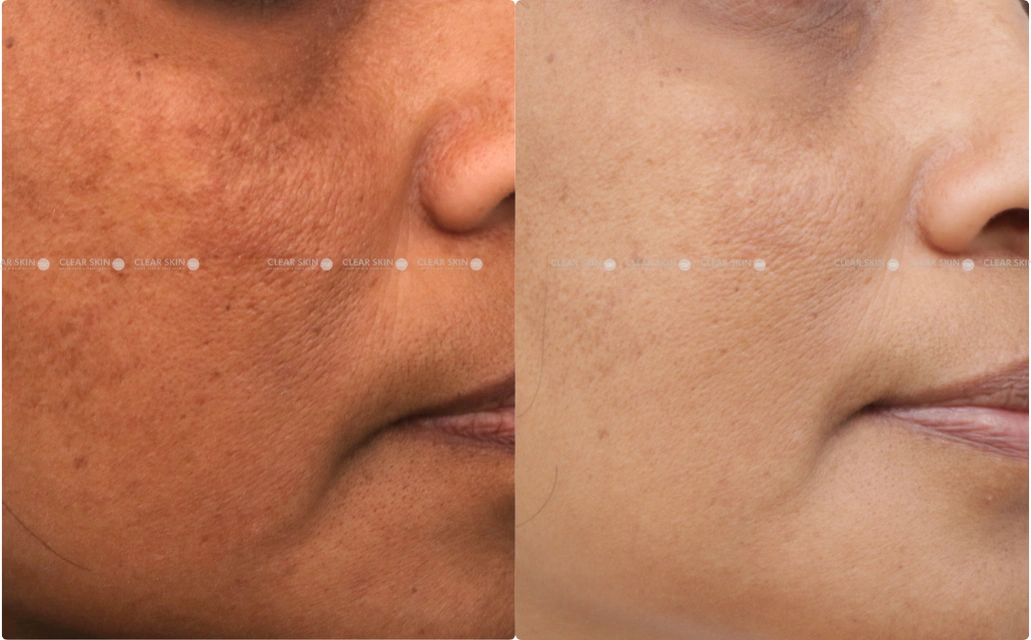 Anti Aging Results 4 Months 5 Sessions Clear Skin Pune