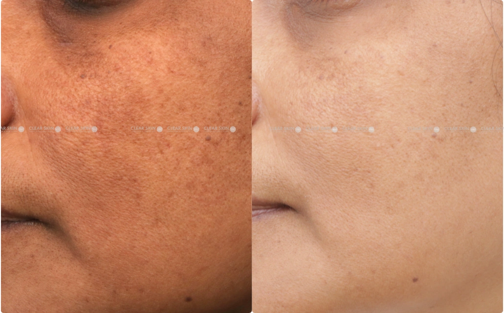 Anti Aging Results 4 Months 5 Sessions Clear Skin Pune