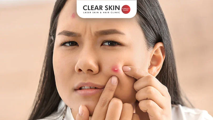 Blind Pimple Causes Clear Skin Pune