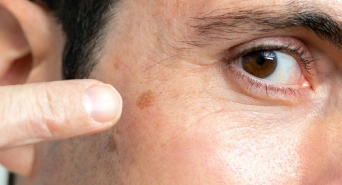 Brown Patches on Skin