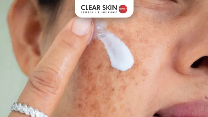 Can Melasma Cream Really Lighten Your Skin?