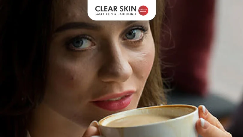 Coffee and Acne Clear Skin Pune