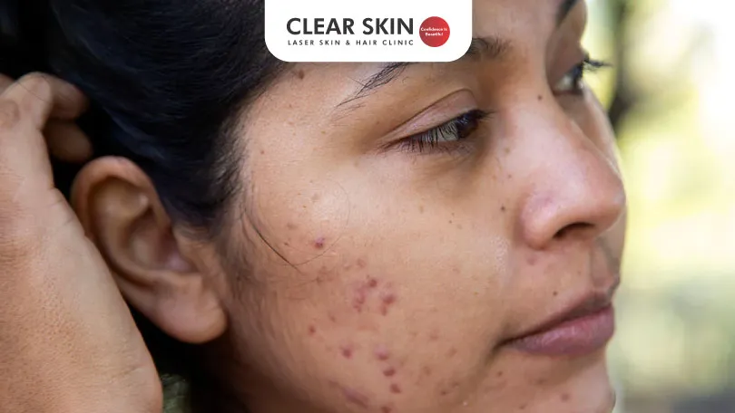 Distinguishing Acne Marks from Acne Scars