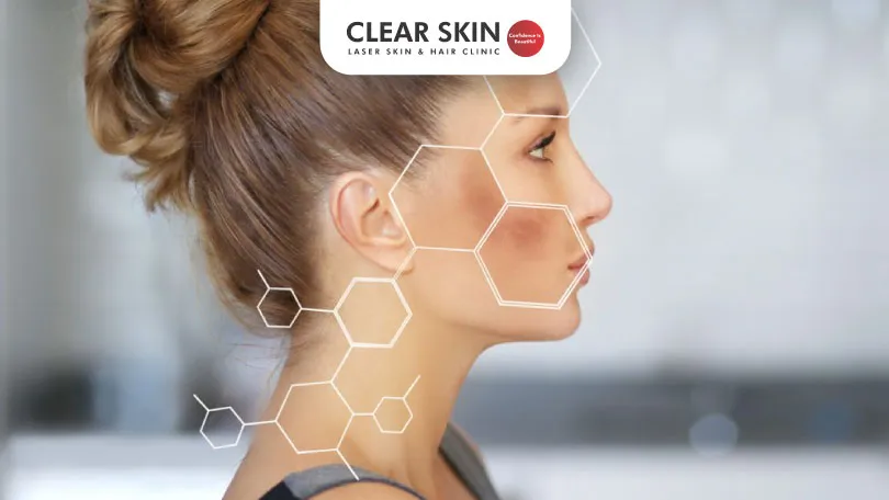 Does Iron Deficiency Cause Melasma Clear Skin Pune