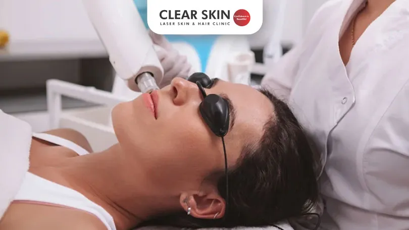 Does Laser Hair Removal Cause Acne and How to Treat It?