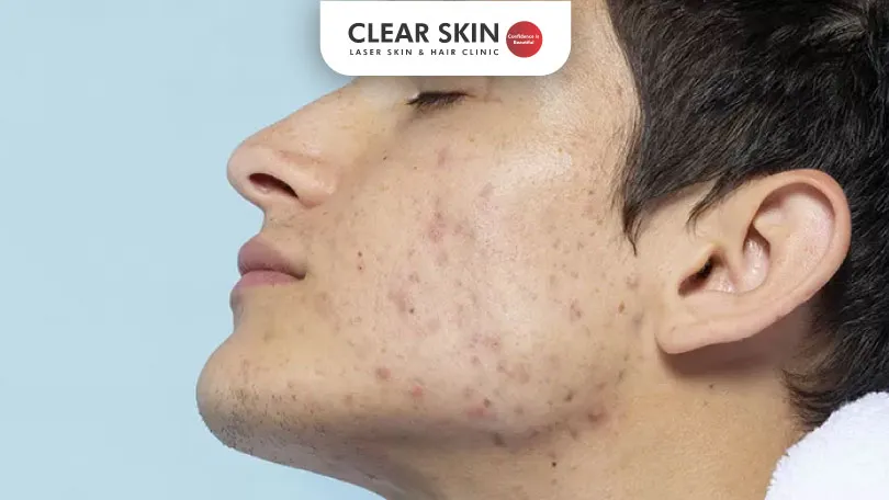 Does Masturbation Cause Acne Clear Skin Pune