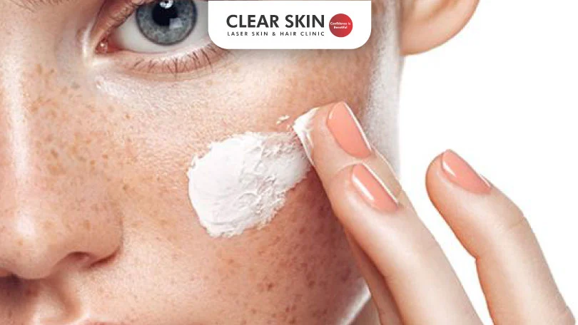 Effective Skin Lightening Creams for Melasma: What Really Works