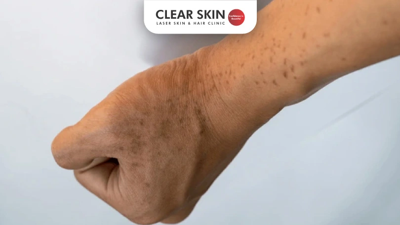 Effective Tips to Remove Dark Spots on Hands