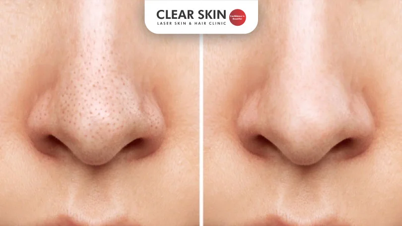 Eliminating Black Nose Spots: Clearing Up Black Dots