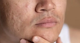 Extensive Acne Scars