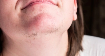 Hirsutism