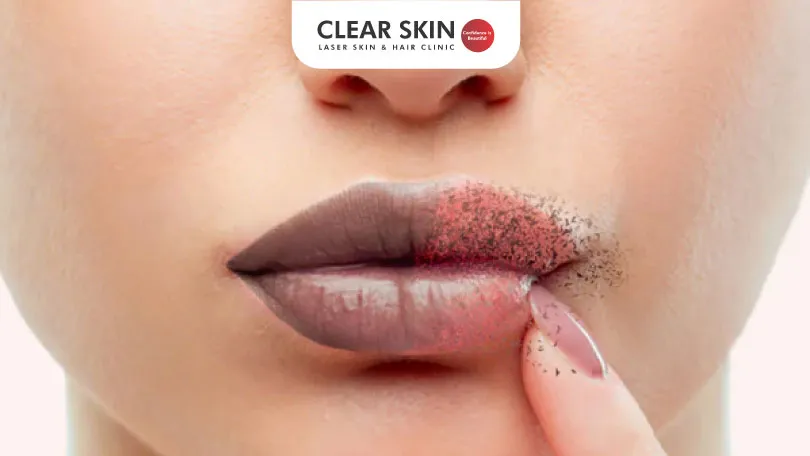 How to Reduce Lip Pigmentation : Effective Methods