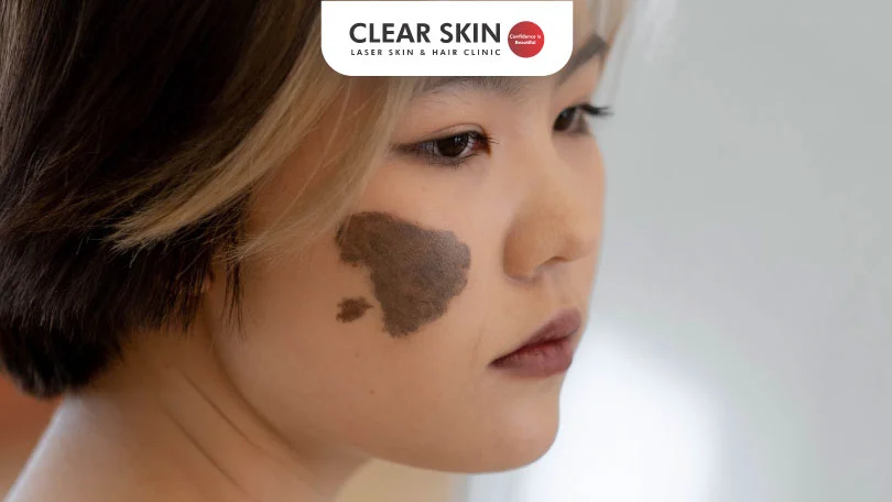 How to Remove Birthmarks from Face Clear Skin Pune