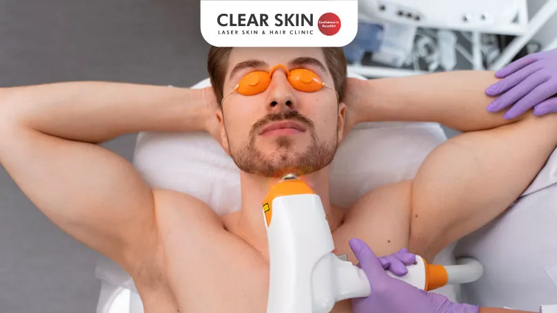 Laser Hair Removal for Men: Comprehensive Guide