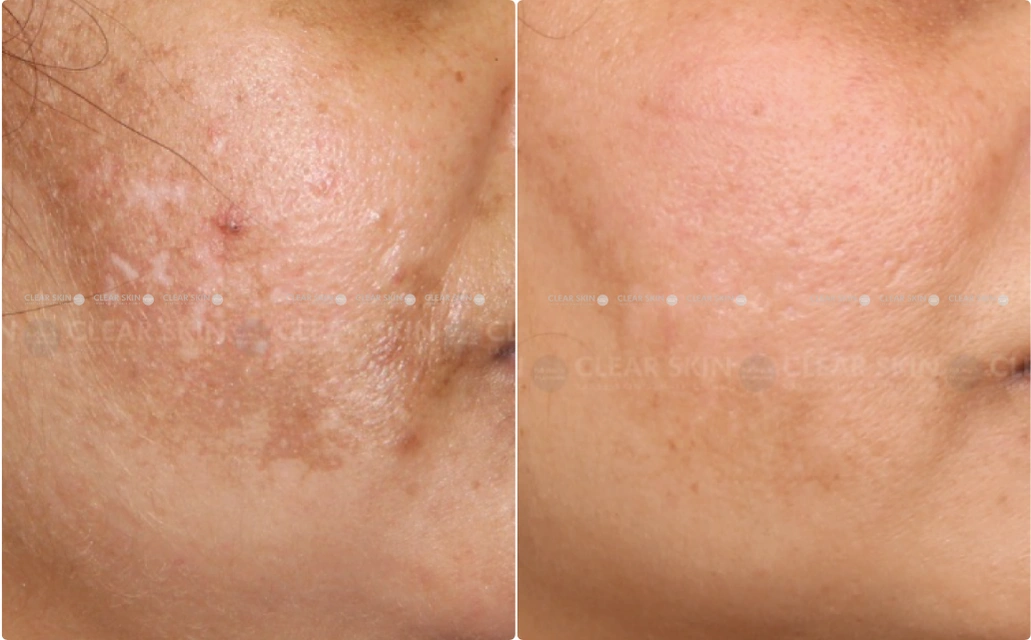 Melasma Results 5 Sessions 4 Months Clear Skin Pune