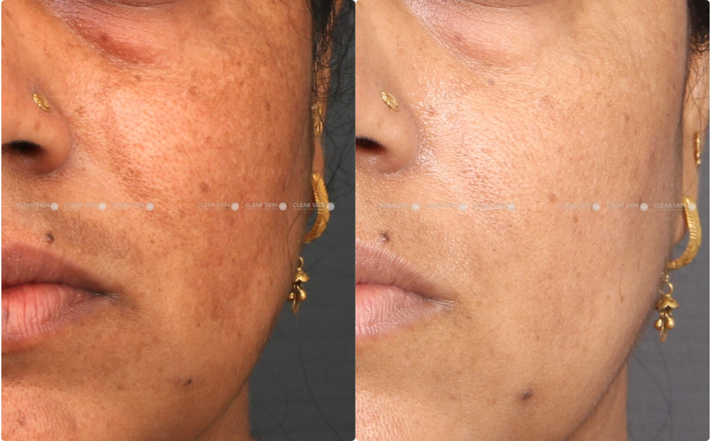 Melasma Results 6 Months Timeline 5 Sessions ClearSkin Pune