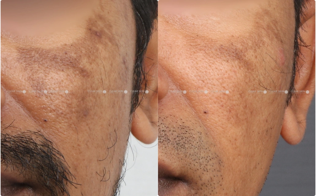 Melasma Results 9 Sessions 10 Months Clear Skin Pune 2