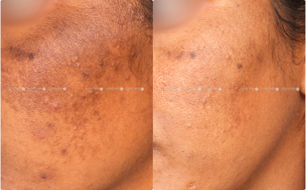 Melasma Results 9 Sessions 10 Months Clear Skin Pune