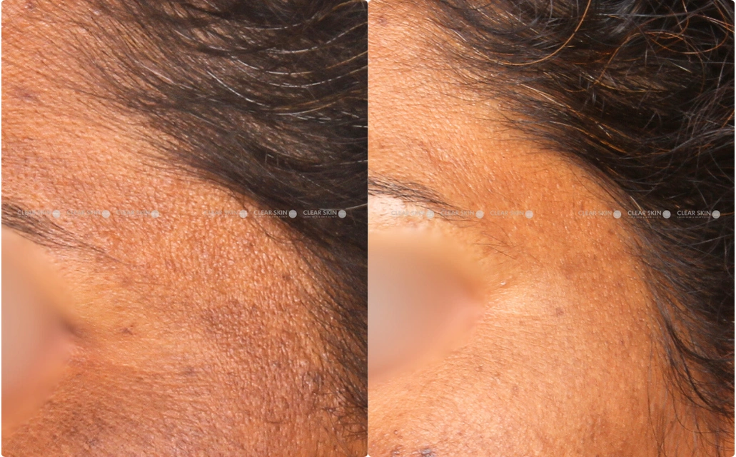 Melasma Results 9 Sessions 10 Months Clear Skin Pune 1