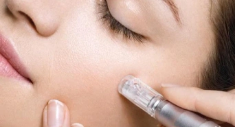 Microneedling