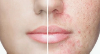 Persistent or Severe Acne