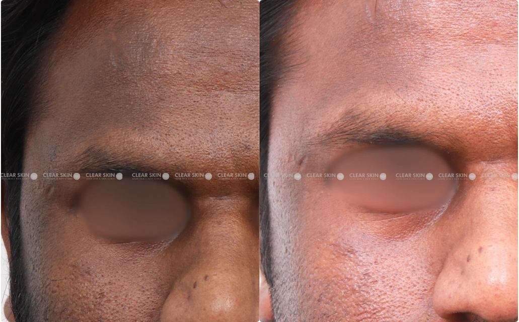 Pigmentation Results 4 Sessions 4 Months Clear Skin Pune