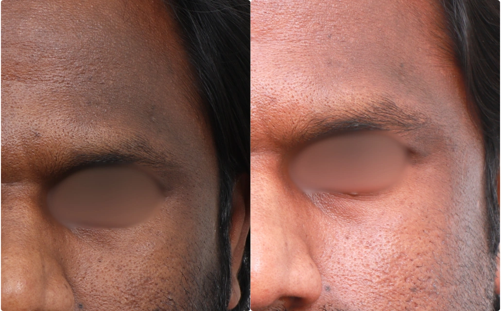 Pigmentation Results 4 Sessions 4 Months Clear Skin Pune (2)