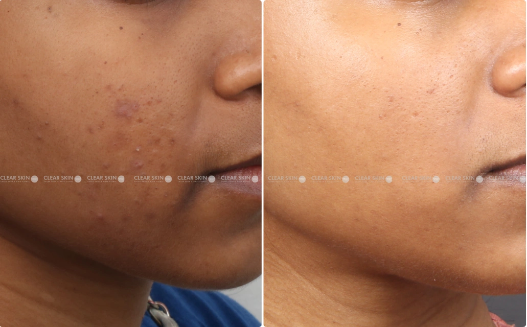 Pigmentation Results 5 Months Timeline 6 Sessions Clear Skin Pune