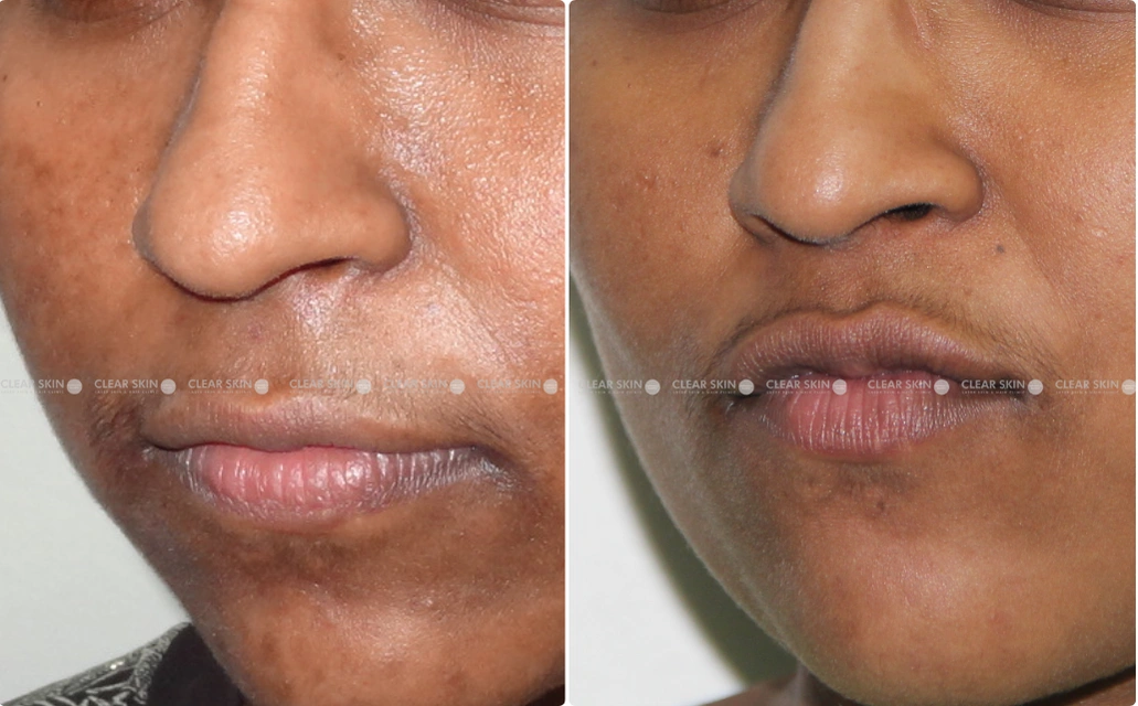 Pigmentation Results 6 Months Timeline 8 Sessions Clear Skin Pune