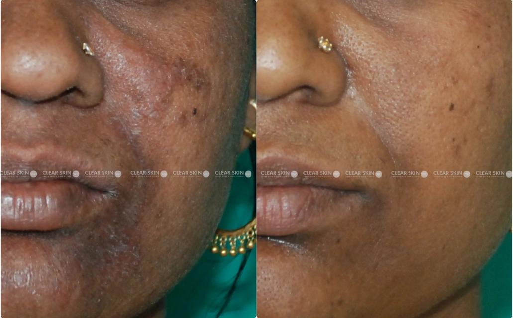 Pigmentation Results 6 Months Timeline 7 Sessions Clear Skin Pune