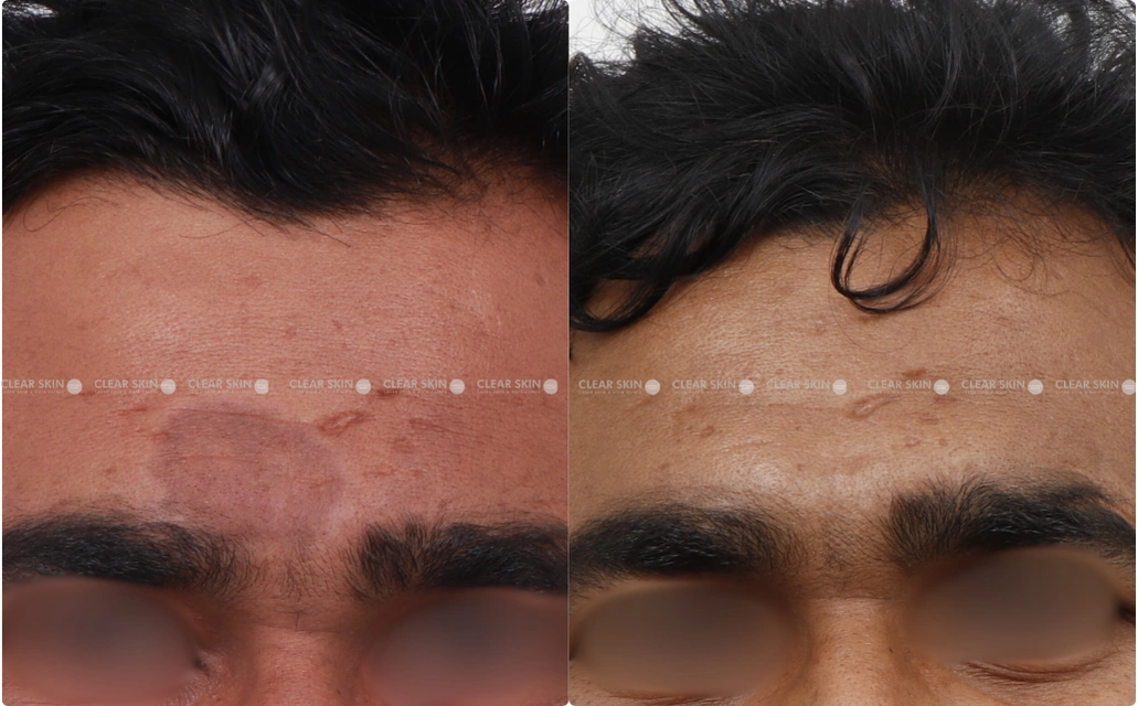 Pigmentation Results 9 Sessions 9 Months Clear Skin Pune