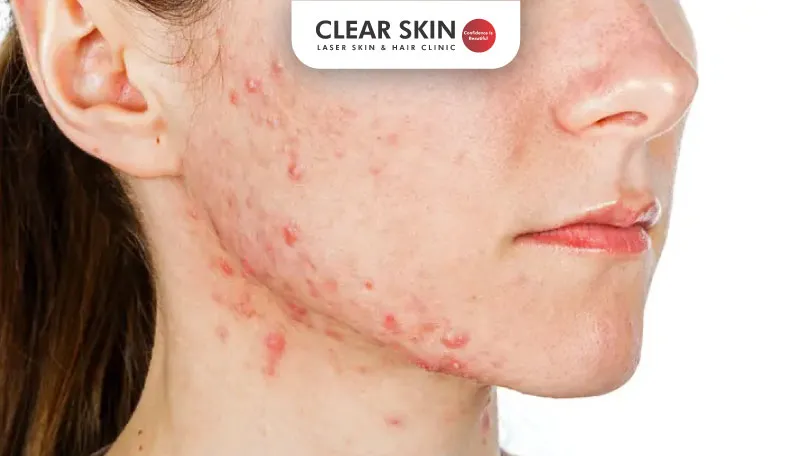 Preventive Measures and Causes of Steroid Acne