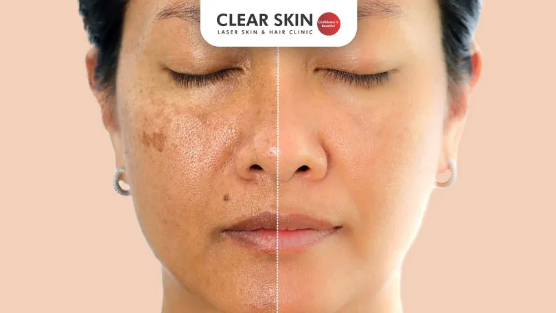 Reasons for Pigmentation on Face