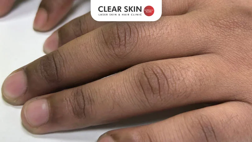 Say Goodbye to Dark Knuckles Clear Skin Pune