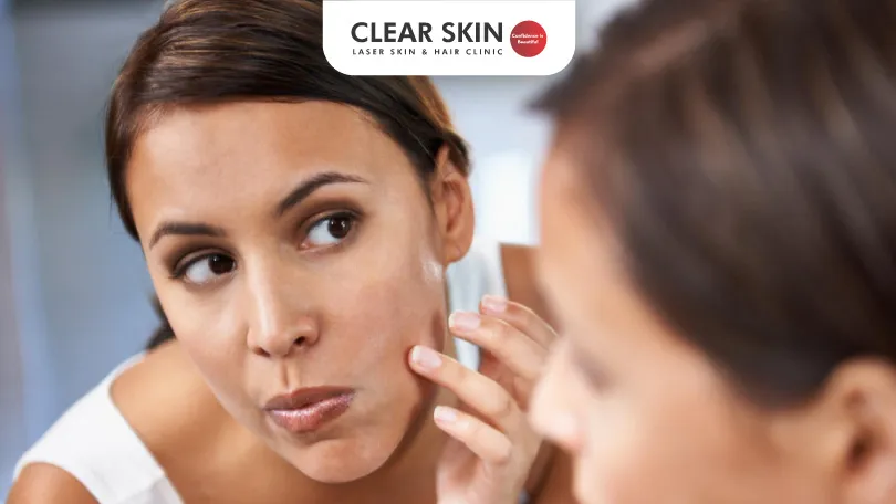 The Ultimate Skincare Routine For Acne Prone Skin Clear Skin Pune