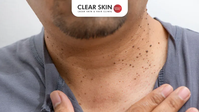 Understanding-Dermatosis Papulosa Nigra DPN Clear Skin Pune