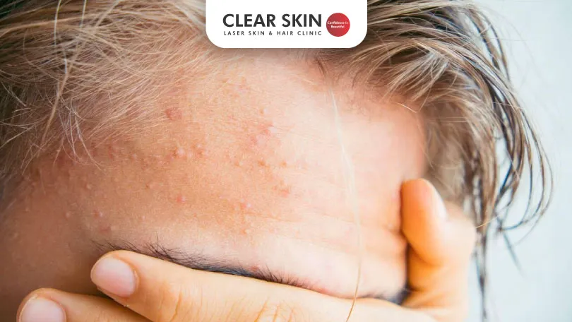 Understanding and Treating Forehead Acne Clear Skin Pune