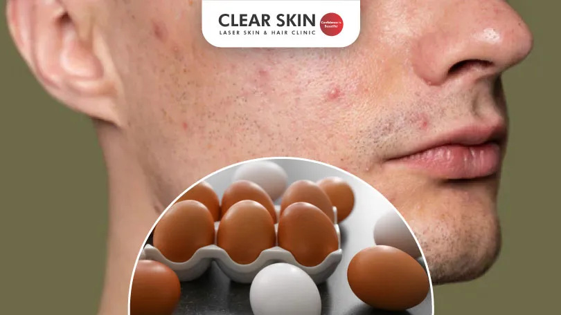 Unravelling the Egg-Acne Connection: What You Need to Know