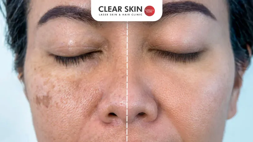 Which Deficiency Causes Melasma on Face?