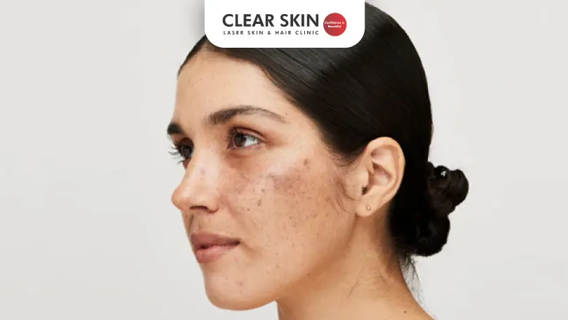 Which Vitamin Deficiency Causes Melasma Clear Skin Pune