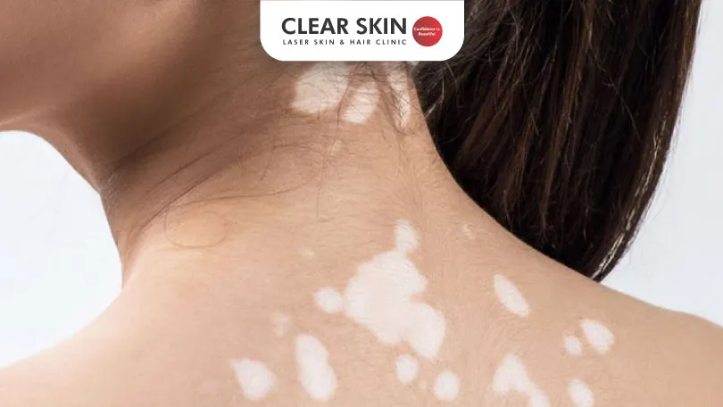 White Patches on Skin: Causes and Effective Treatments