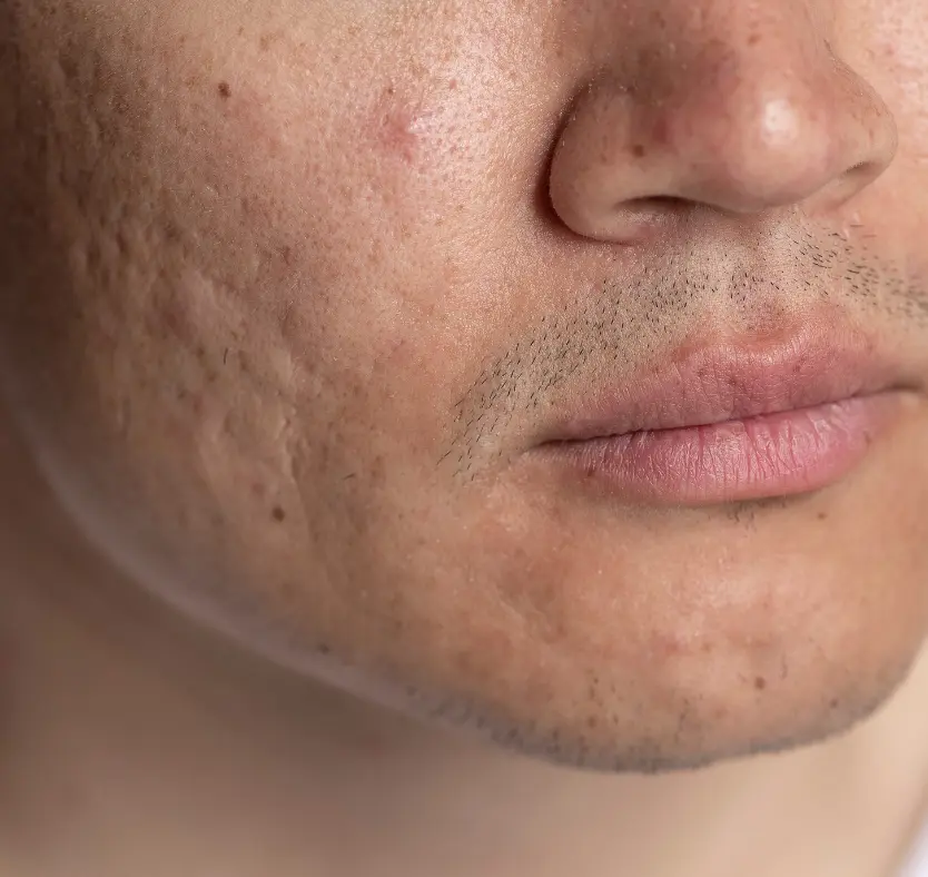 acne scars treatment karad satara