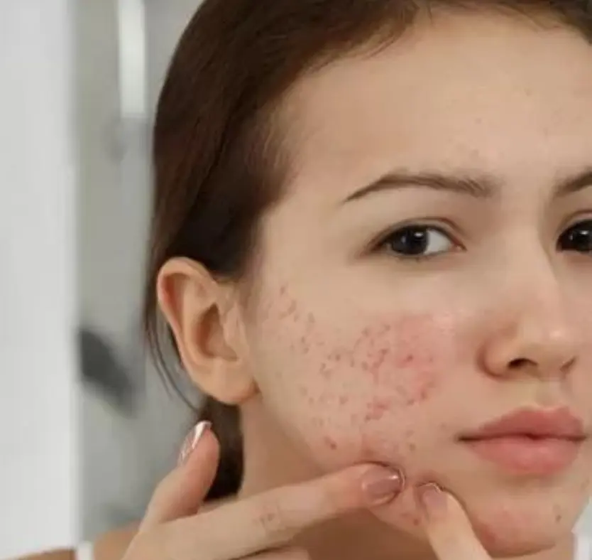 Acne Skin Treatments At Clear Skin karad