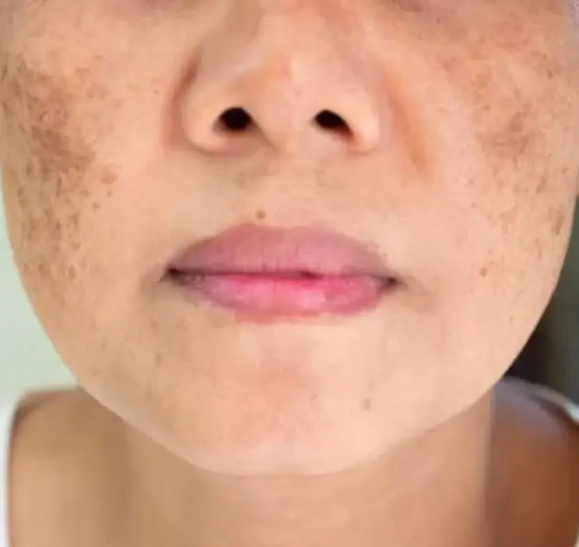 melasma treatment pune