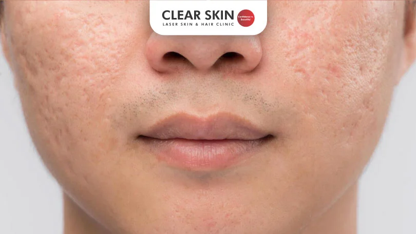 चेहऱ्यावरील मुरूम व पुळ्या जाण्यासाठी काय उपाय करावे Clear Skin Pune