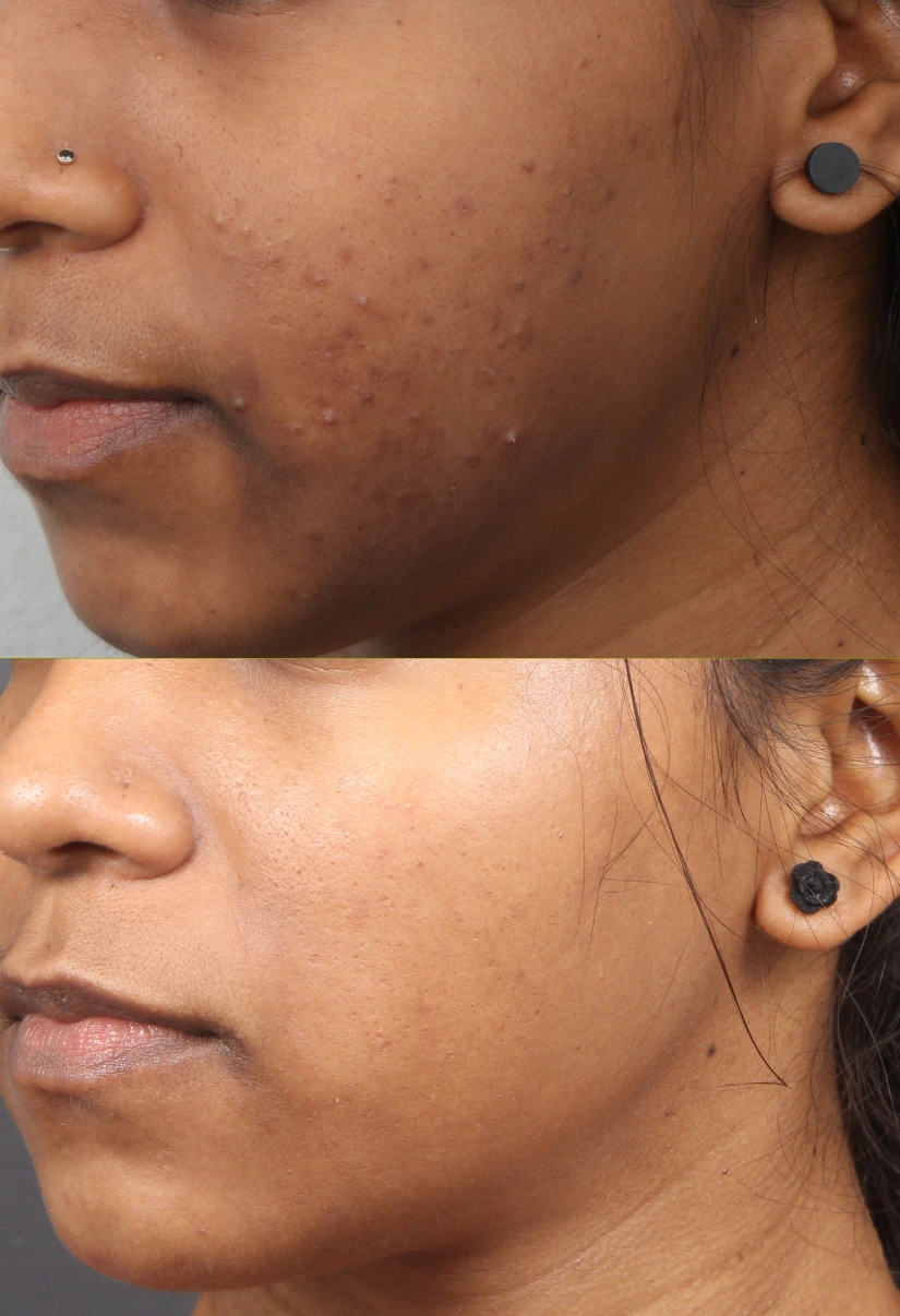 19yrs Pigmentation Results 4 Months Timeline 6 Sessions ClearSkin Pune (2)