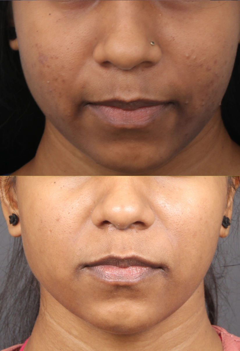 19yrs Pigmentation Results 4 Months Timeline 6 Sessions ClearSkin Pune